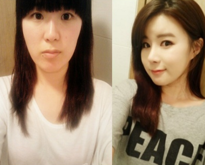 Jungah’s Plastic Surgery Real Review