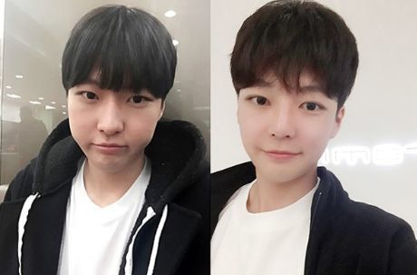 Minwoo’s Plastic Surgery Real Review