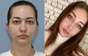 Vika’s Plastic Surgery Real Review.
