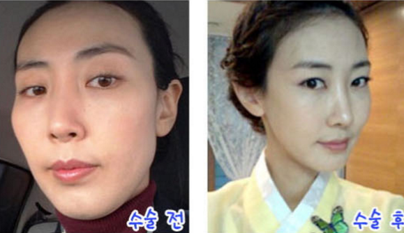 Peanut’s Plastic Surgery Real Review