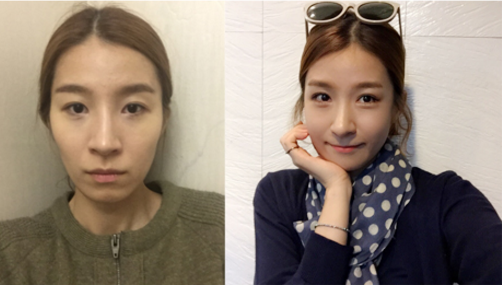 Youngjoo’s Plastic Surgery Real Review