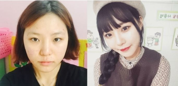 Yejin’s Plastic Surgery Real Review
