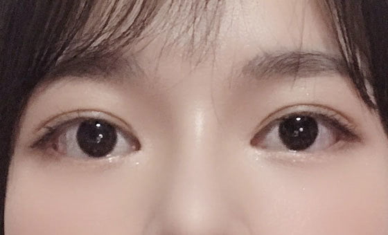 หลังแก้ไขกล้ามเนื้อตาอ่อนแรง