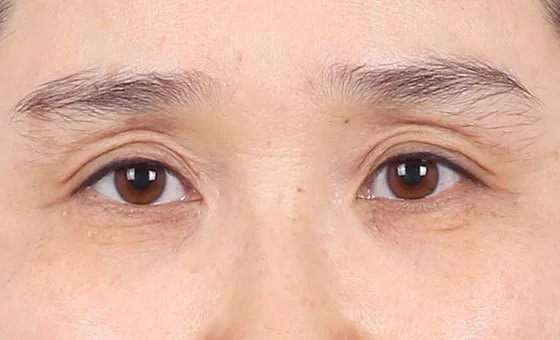 ก่อนศัลยกรรมหนังตาบน