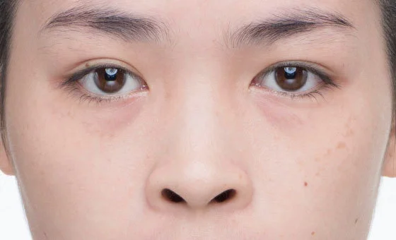 ตัดปีกจมูก ก่อน