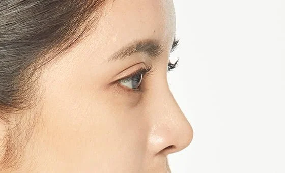 เสริมจมูก หลัง