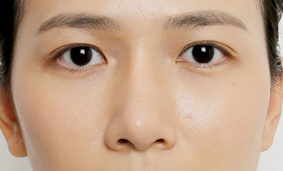 แก้ไขจมูก ก่อน