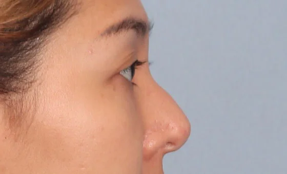 ลดฮัมพ์ ก่อน